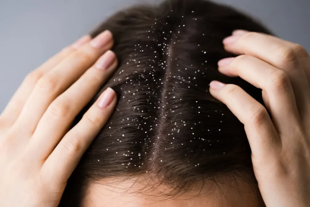 Dandruff in scalp. 